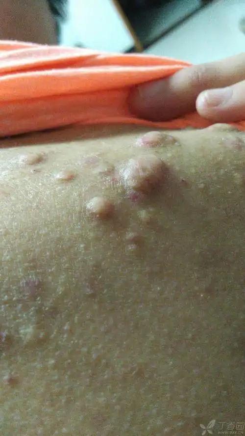 瘢痕疙瘩 - 皮肤性病 - 专业医生社区,医学,药学,生命科学,科研学术